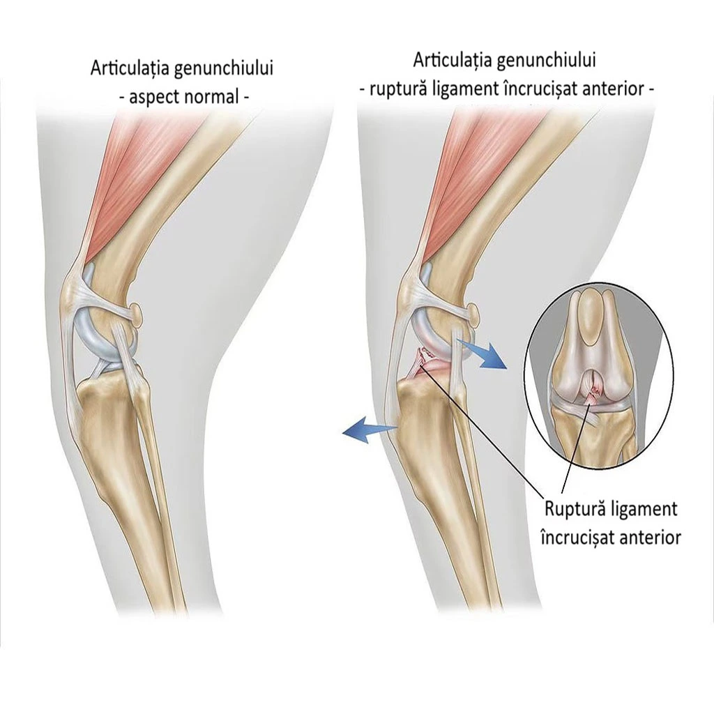 Ruptura ligament cruciat anterior