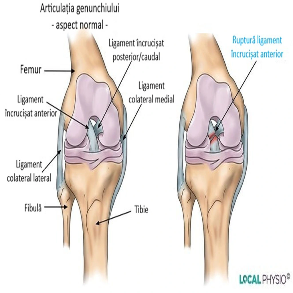 Ruptura ligament incrucisat anterior
