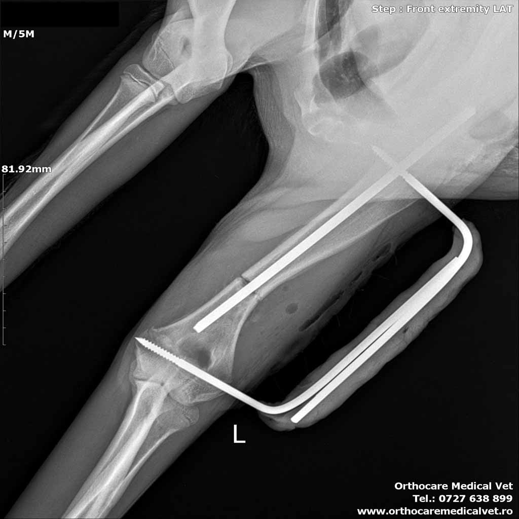 Fractura humerus caine