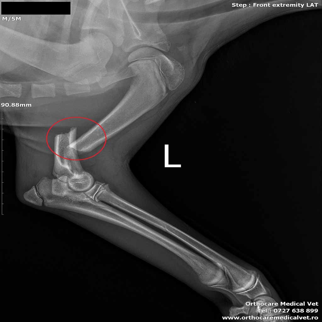 Fractura humerus caine