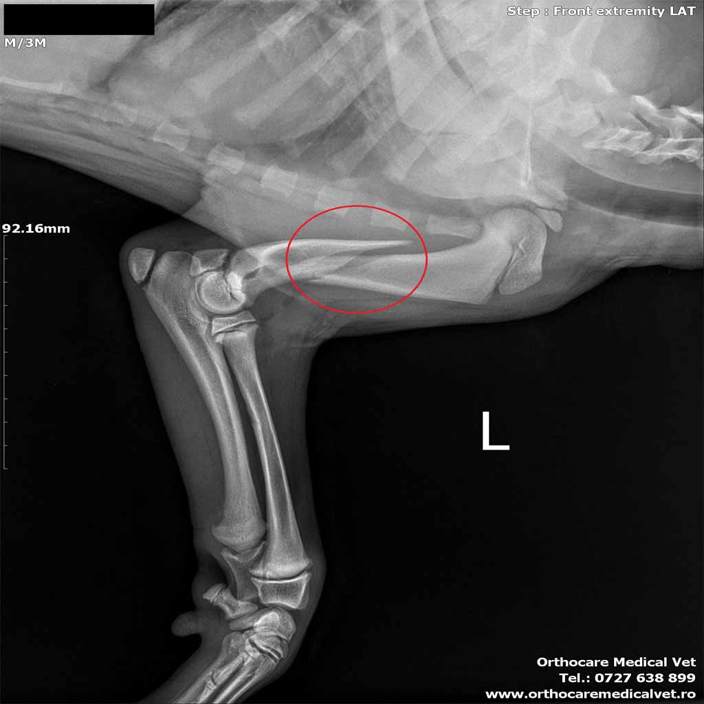 Fractura humerus caine