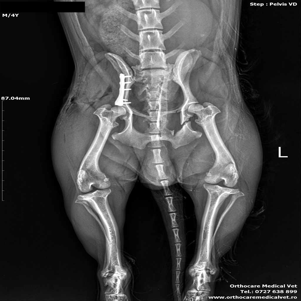 Fractura bazin caine