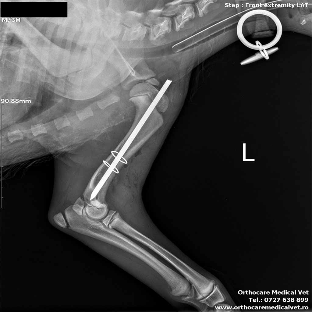 Fractura humerus caine