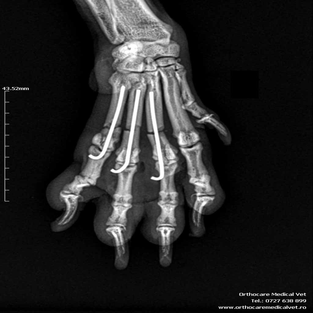 fractura metacarpiene caine