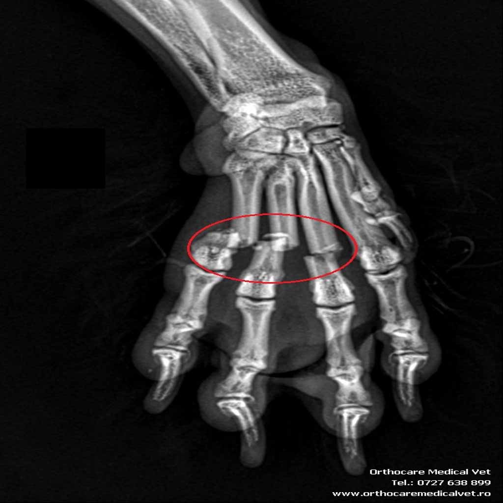 fractura metacarpiene caine