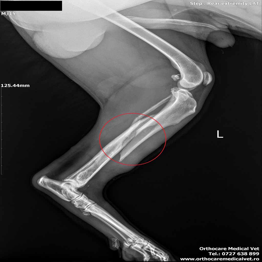 fractura tibie caine